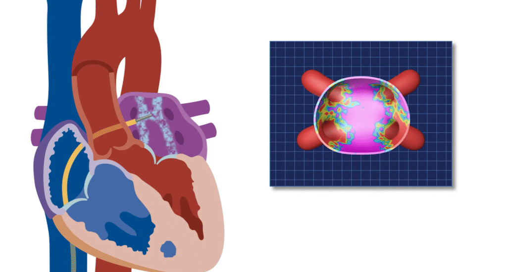 Pulsed Field Ablation