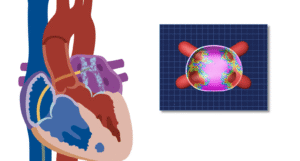 Pulsed Field Ablation